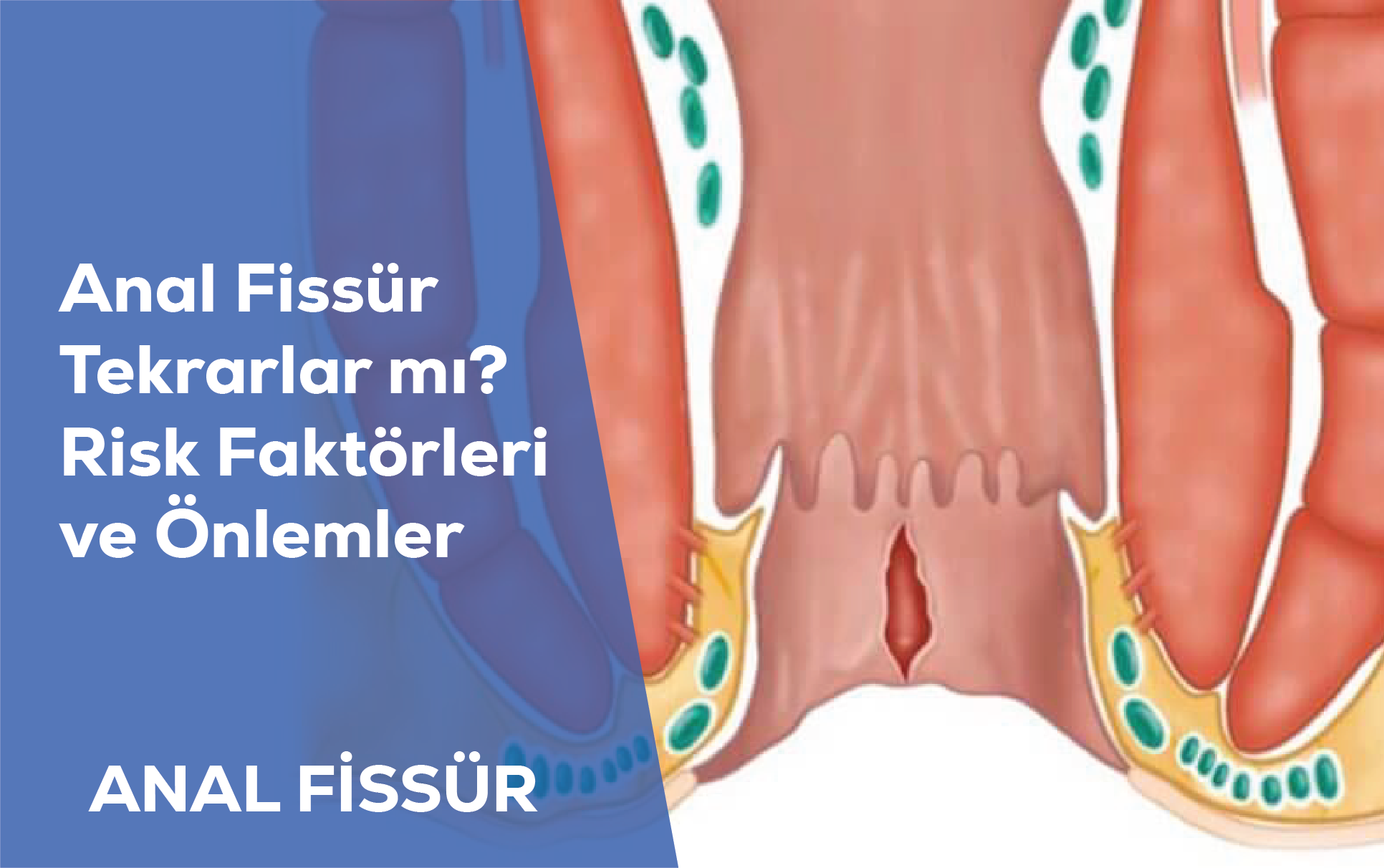 Anal Fissür Tekrarlar mı? Risk Faktörleri ve Önlemler